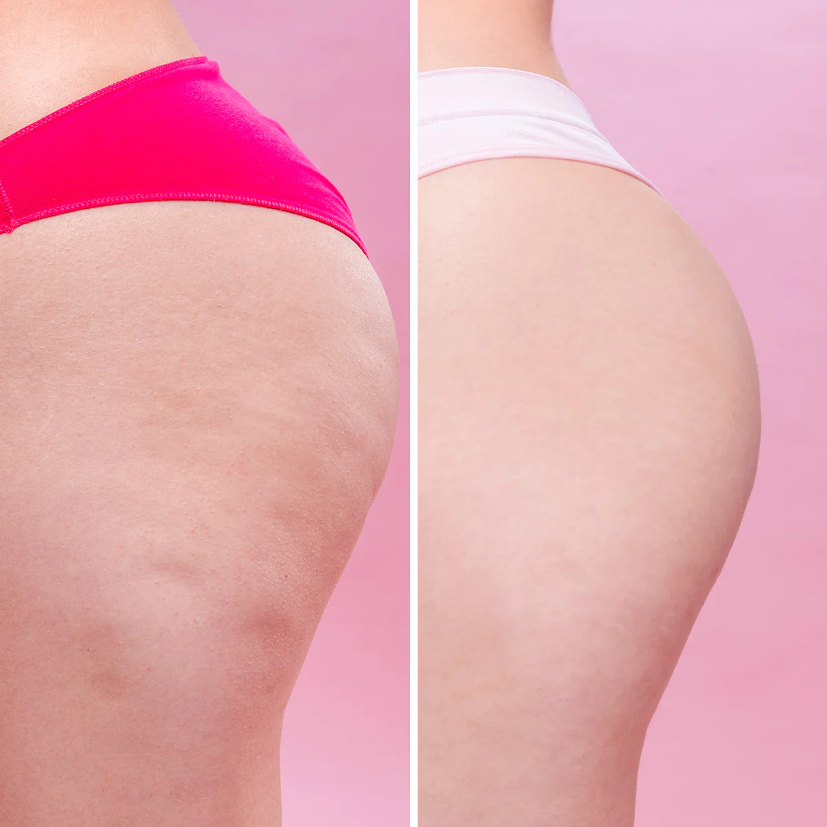 Cellulite Remover - Image 7