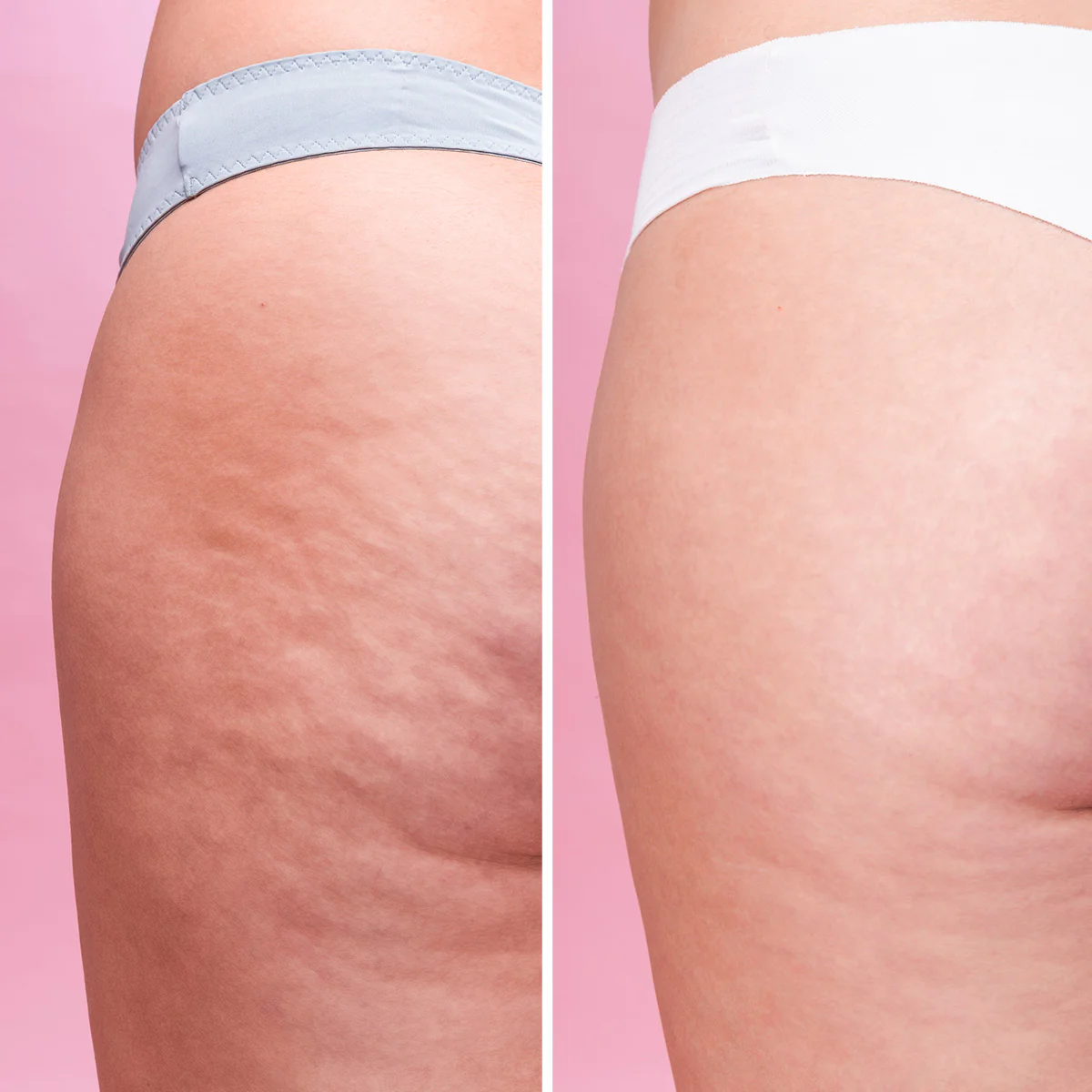 Cellulite Scrub - Image 7