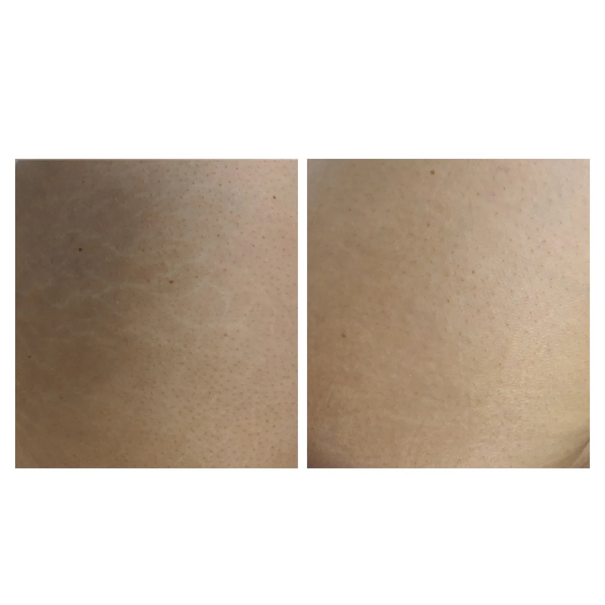 Crema Corpo Smagliature e Cicatrici - Image 4